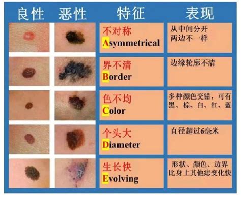 胸部痣|痣